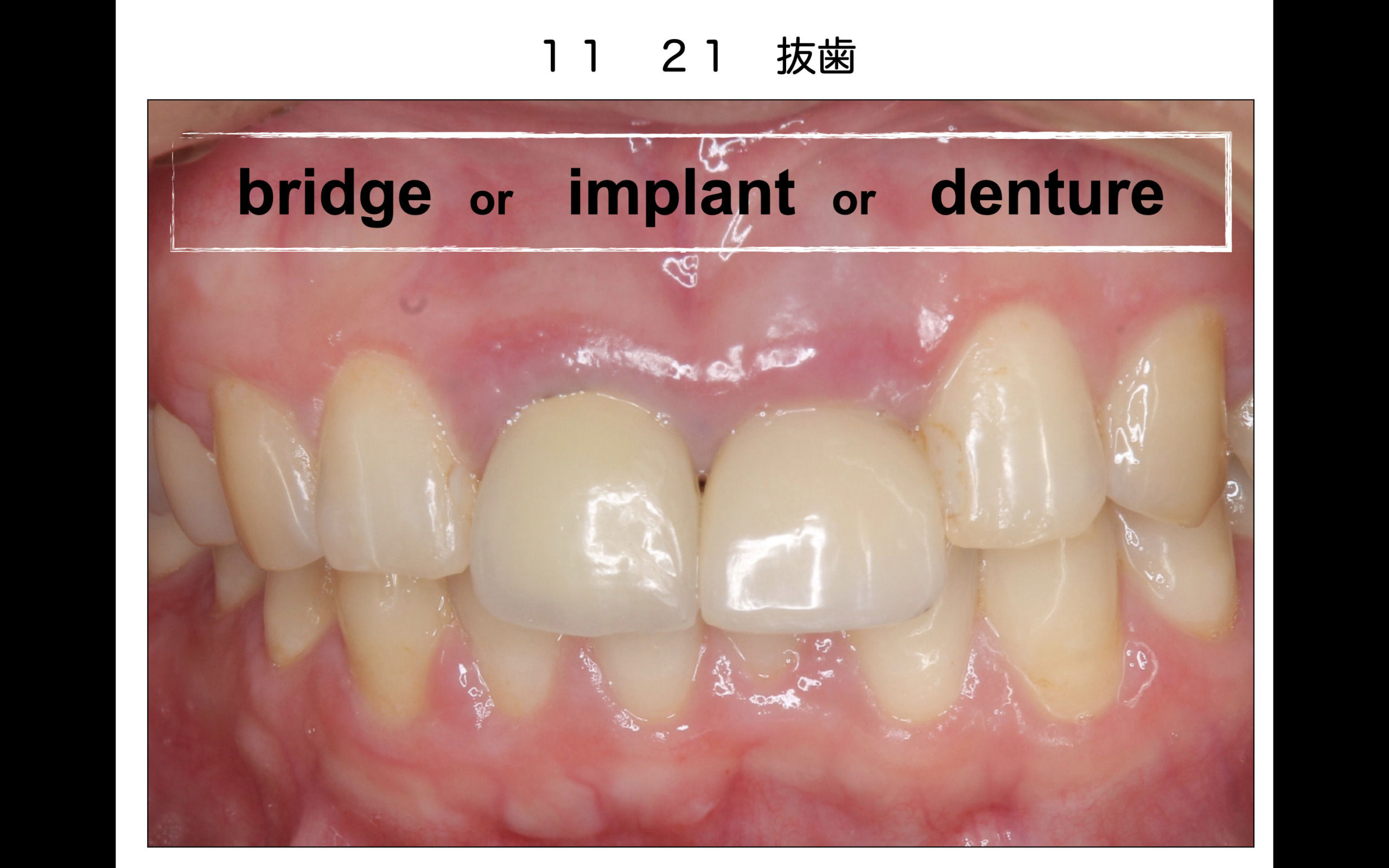 前歯のインプラント治療は診査診断治療計画が大事（4） | 氏井歯科矯正 