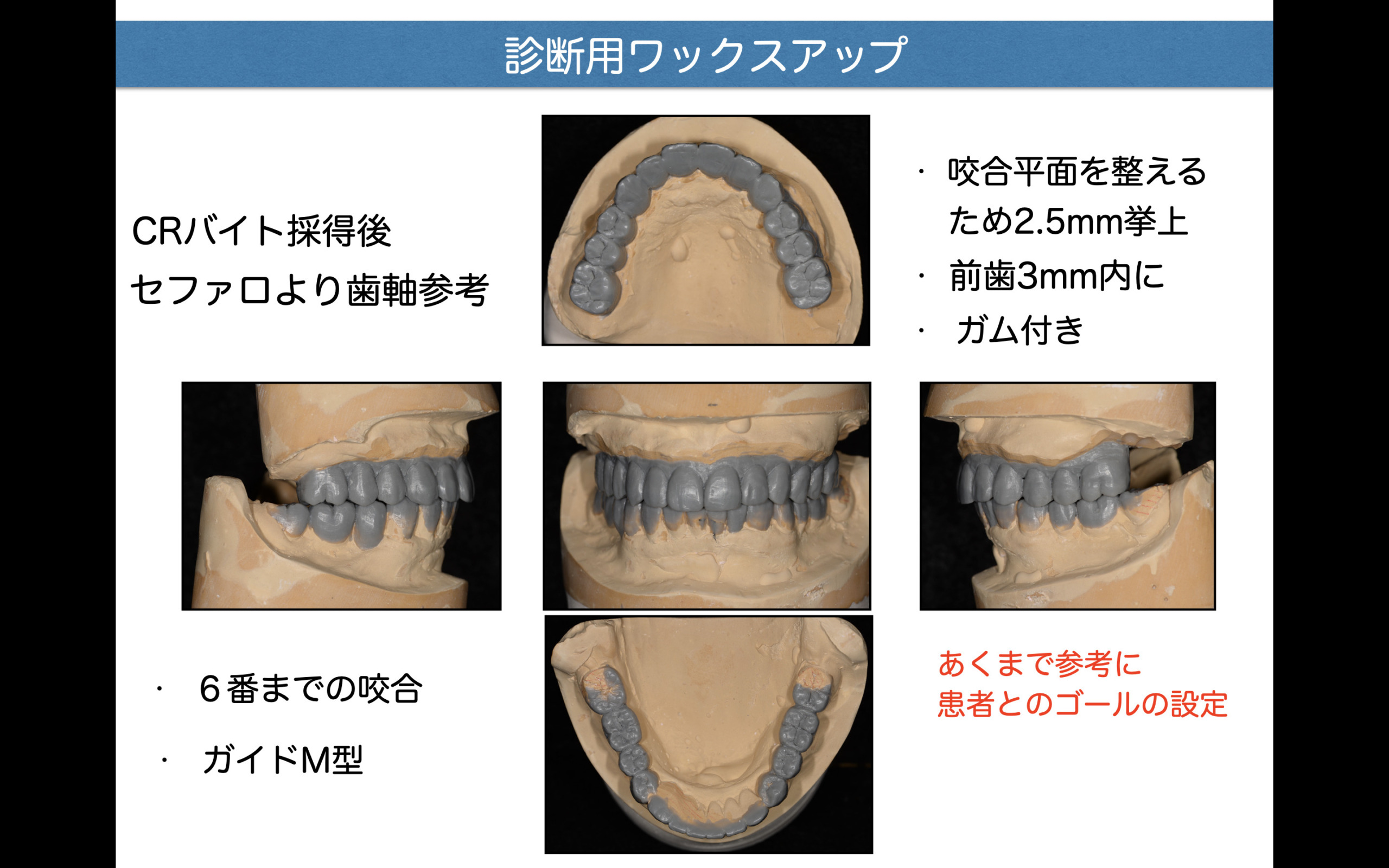 咬合崩壊した高齢者に対してインプラントを用いて早期QOLの回復を