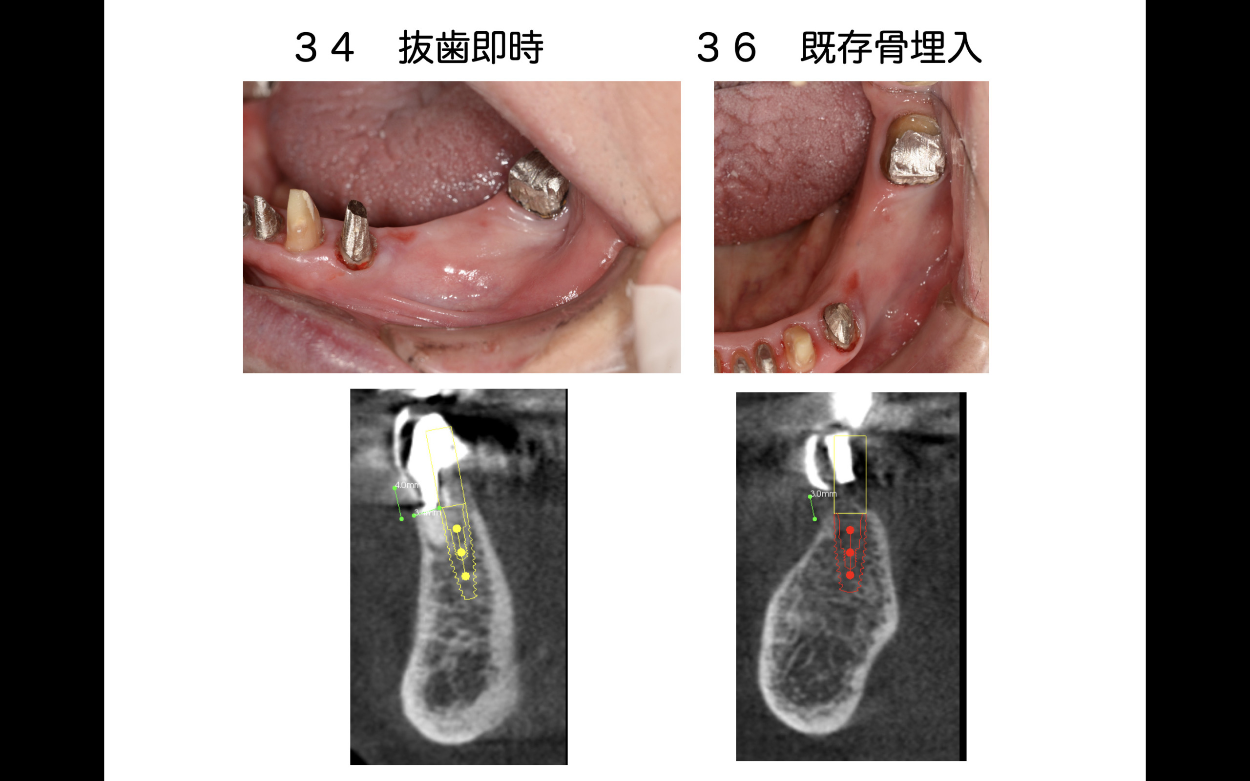 【裁断済み】咬合治療　失敗回避のためのポイント38 咬合崩壊した高齢者に対してインプラントを用いて早期QOLの回復