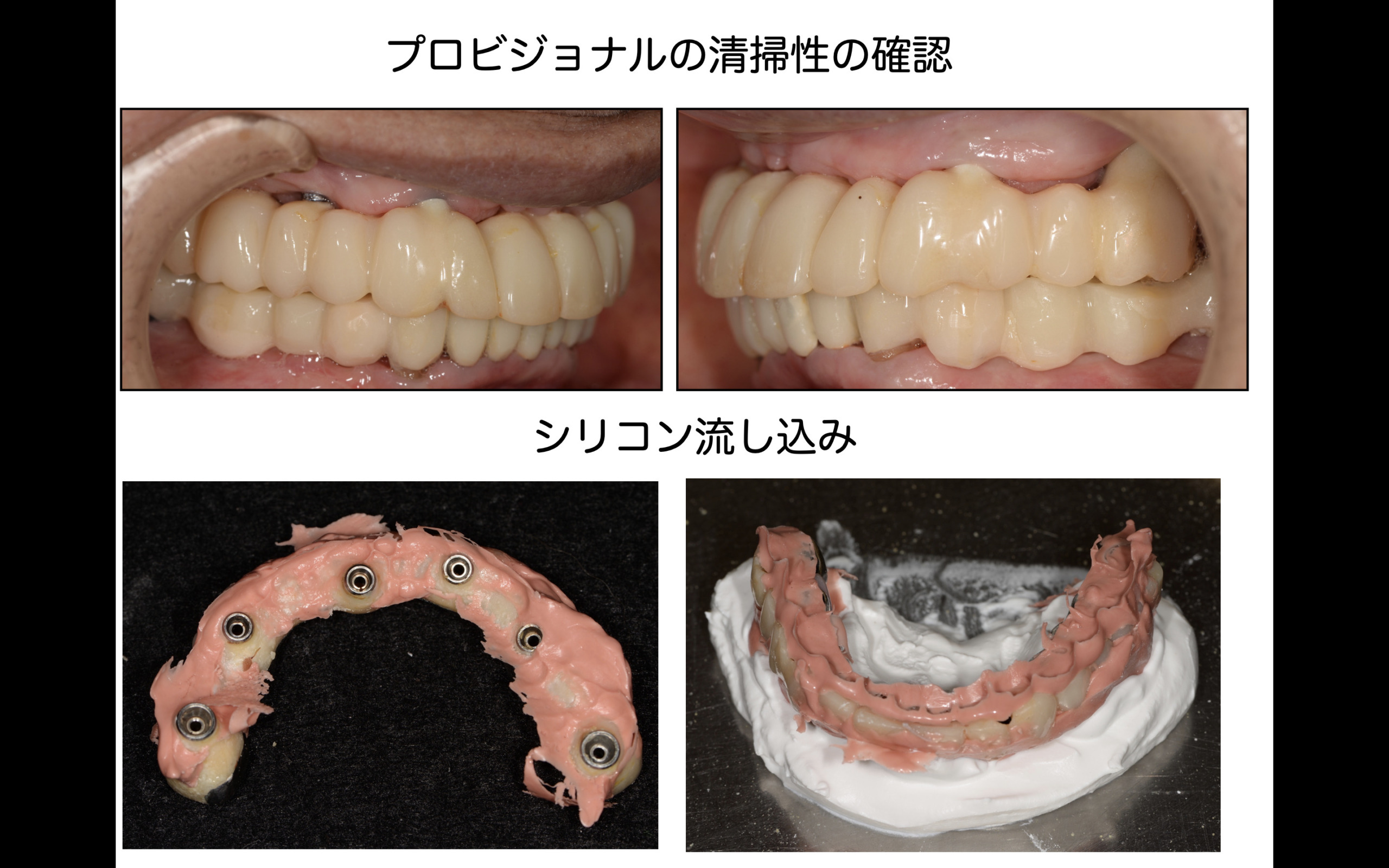 咬合崩壊した高齢者に対してインプラントを用いて早期QOLの回復を目指した症例(10) | 門真市の歯医者なら氏井歯科矯正歯科