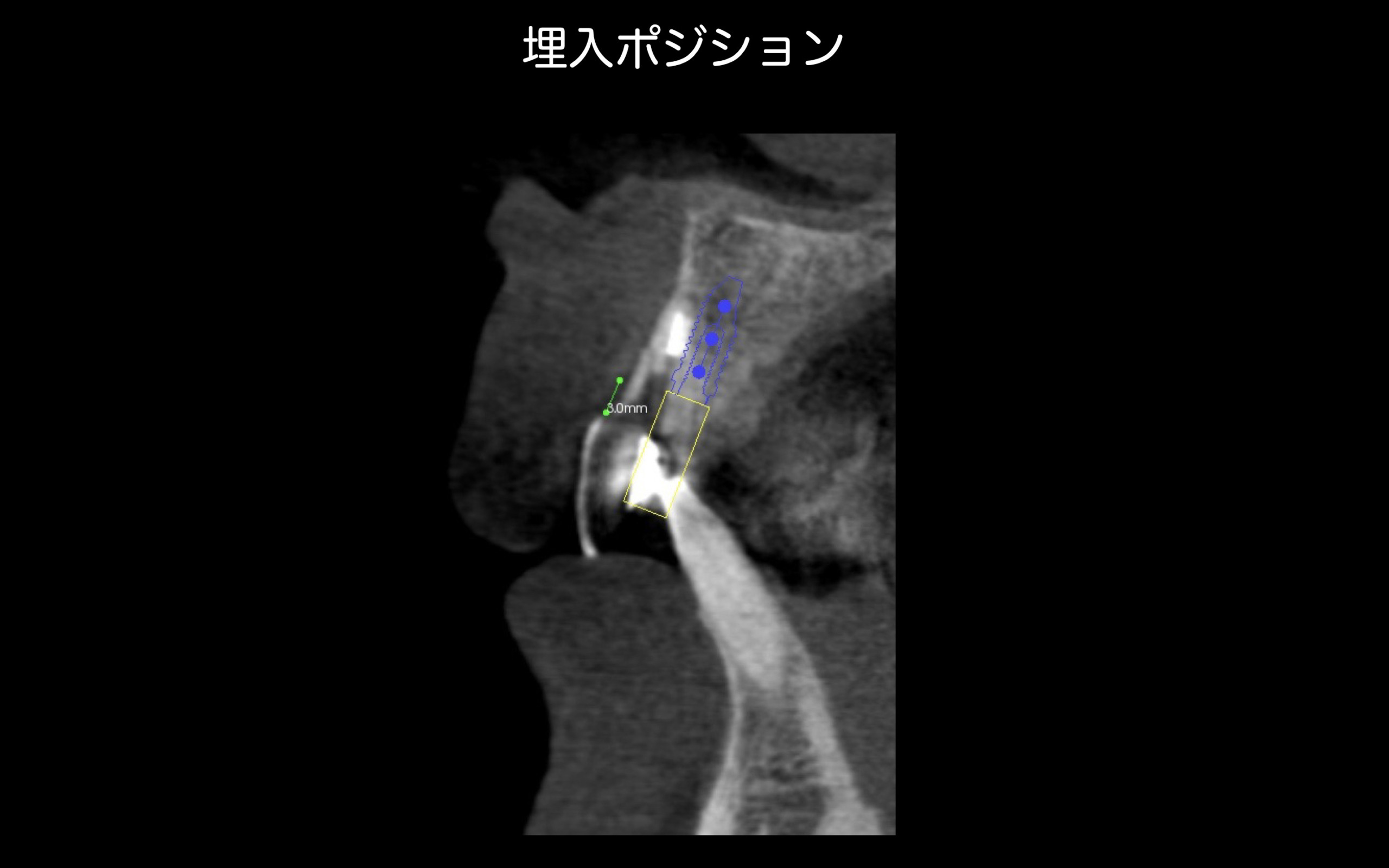 矯正が先か? インプラントが先か? : 欠損補綴の治療計画を極める 多数歯欠損をインプラントと補綴（セラミック）治療にて咬合再