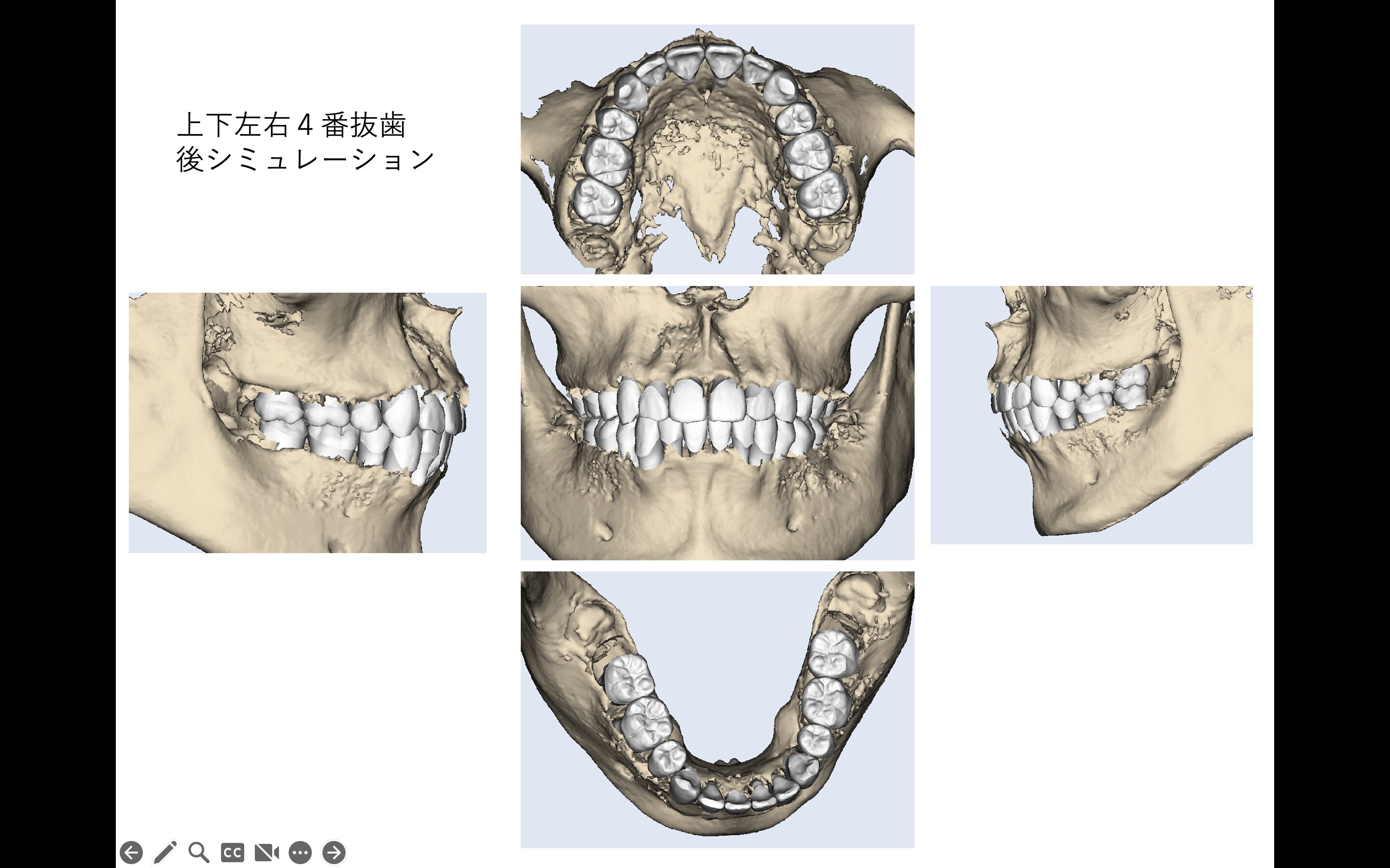 口腔内スキャンデータを用いた抜歯矯正のシミュレーション